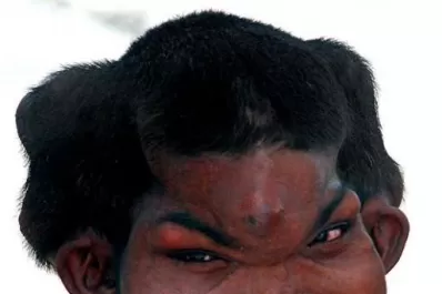 El dramático caso del “hombre elefante”