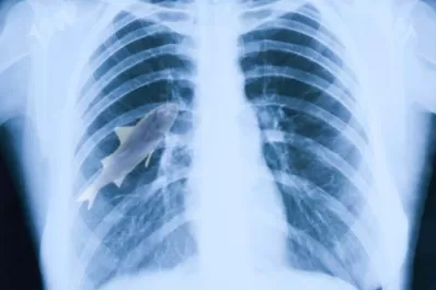 Extrajeron un pez vivo del pulmón de un niño