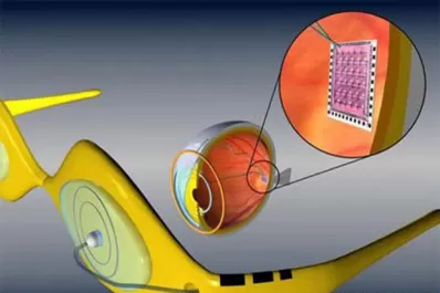 Ya hay implantes biónicos para recuperar la visión