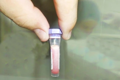 Un bebé nació con sangre blanca y dejó a todos los médicos desconcertados