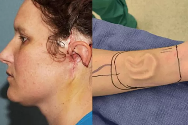 Le ponen una oreja amputada en el brazo