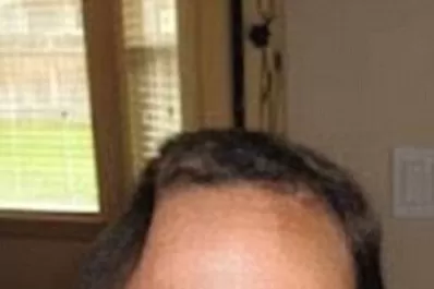 Le implantaron parte del cráneo en el estómago a una mujer