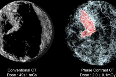 Un escáner deja ver el cáncer de mama en tres dimensiones