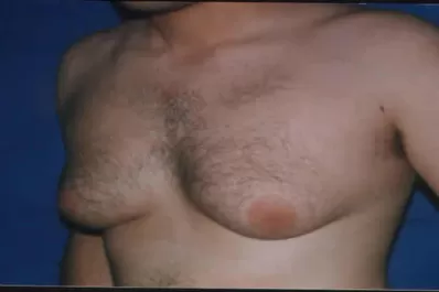 Alerta máxima en Alemania por epidemia de senos en soldados