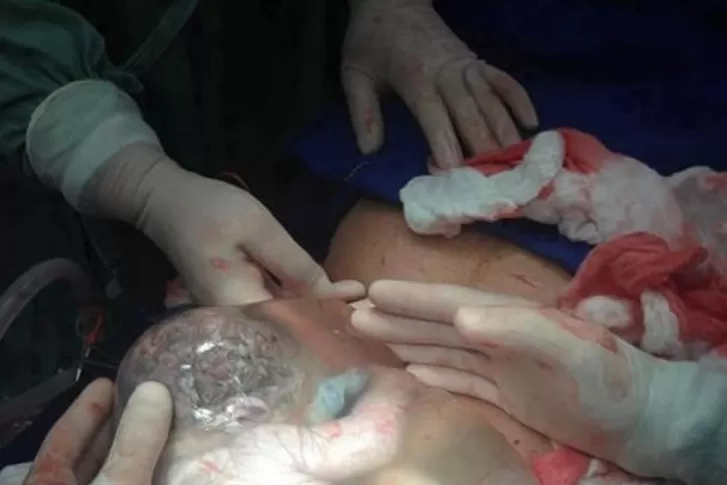 SORPRESA. El bebé continuaba dentro del saco amniótico al ser extraído del vientre de su madre. FOTO TOMADA DE NEWS247.GR