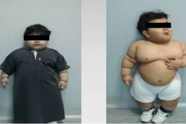 Con dos años pesaba 35 kilos: lo sometieron a una reducción de estómago