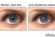 Con el paso de los años aparecen las arrugas, las canas y también las cataratas