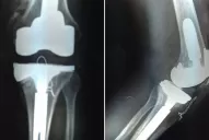 La maldita rodilla de Ricardo Fort