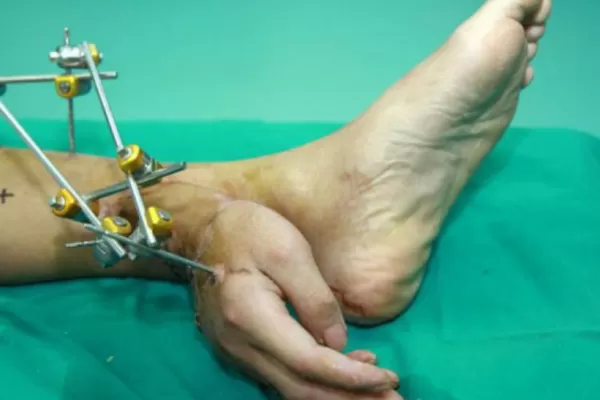 Le implantaron una de sus manos en el pie para mantenerla con vida