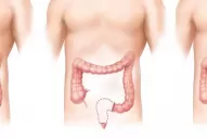 “Fui a consultar por un dolor de estómago y me detectaron cáncer de colon avanzado”