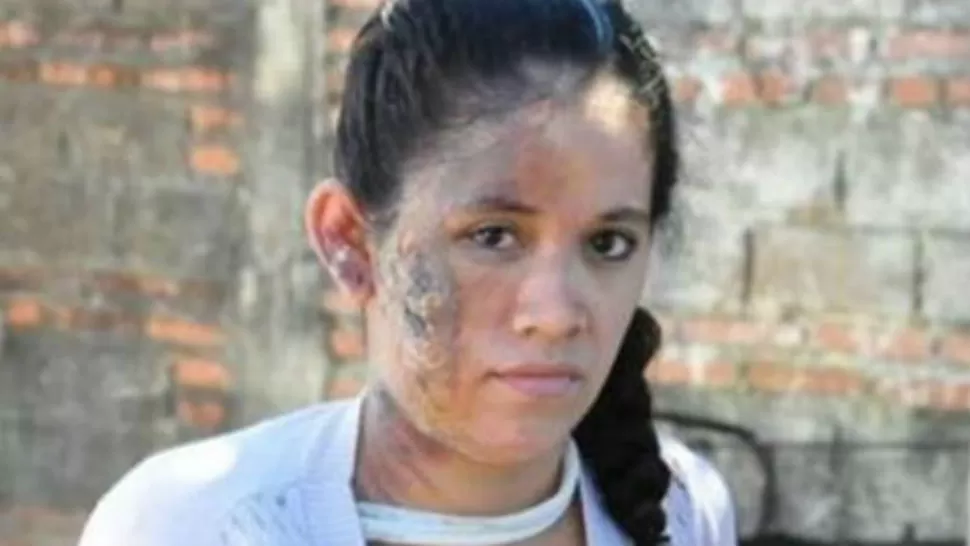 El rostro quemado de la joven. foto de El Litoral de Corrientes