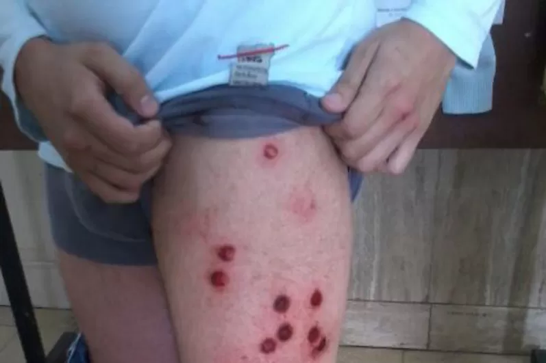 VIOLENCIA. Uno de los heridos muestra las marcas de los impactos en su pierna. FOTO GENTILEZA DAVID VALDIVIA