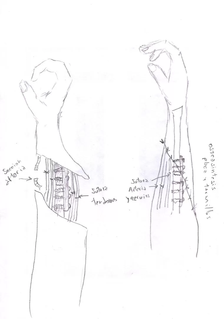 EL REIMPLANTE. Los dibujos a mano alzada del doctor Urpi muestran con precisión el lugar donde fueron ablacionados los miembros superiores: la mano derecha, a la altura del antebrazo; la izquierda, en la muñeca. 