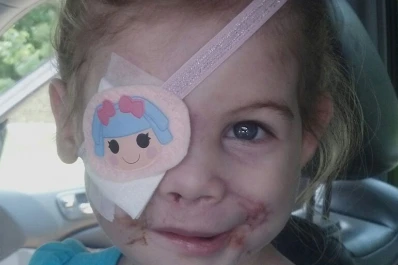 Echan de un restaurante a una niña de 3 años por las cicatrices de su cara