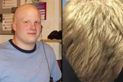 Un fármaco hace que un calvo crónico vuelva a tener una cabellera poblada