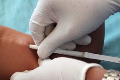 Adolescentes jujeñas podrán acceder en agosto al anticonceptivo por implante subdérmico