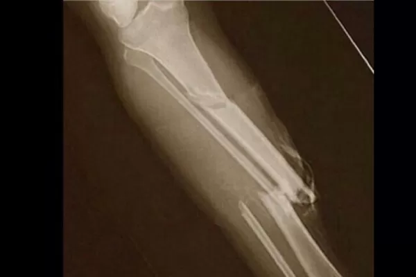 Así quedó la pierna de Paul George tras la fractura de tibia y peroné
