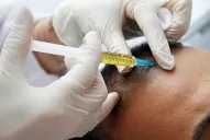 Con medicación e injerto capilar podés recuperar hasta las cejas