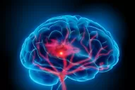 La arritmia cardíaca quintuplica el riesgo de sufrir un ACV