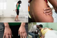 Confirman un caso de fiebre de chikungunya en Tucumán