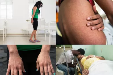 Confirman un caso de fiebre de chikungunya en Tucumán