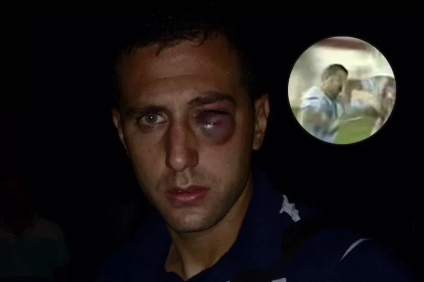 Mirá cómo quedó el ojo Bruno Bianchi después del codazo