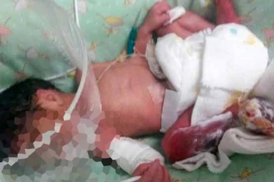 La Pampa: le amputarán una pierna a una beba que fue quemada con un caloventor, en un hospital