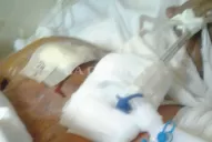 Murió el hombre al que su esposa le habría prendido fuego, en Concepción