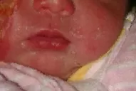 Son dos las bebés que fueron quemadas en una clínica de Famaillá