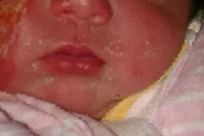 Son dos las bebés que fueron quemadas en una clínica de Famaillá