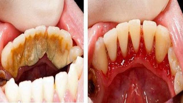 Con que se saca el sarro delos dientes