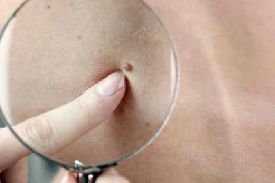 La cantidad de lunares del brazo derecho puede alertar sobre un cáncer de piel