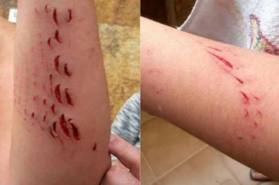 Así le quedó el brazo a una mujer tras ser mordida por un tiburón