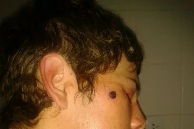 Denuncia que perdió un ojo en un operativo policial