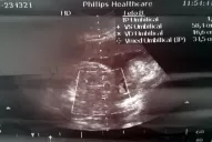 No descarto que lo hayan robado, dijo el abogado de la mujer que esperaba gemelos