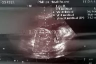 El Gobierno apunta a la ecografista que predijo un embarazo doble