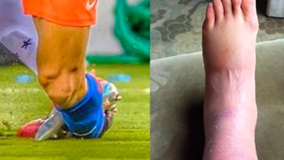 Video: así tiene aún el tobillo Alexis Sánchez por el pisotón de Mercado en la final