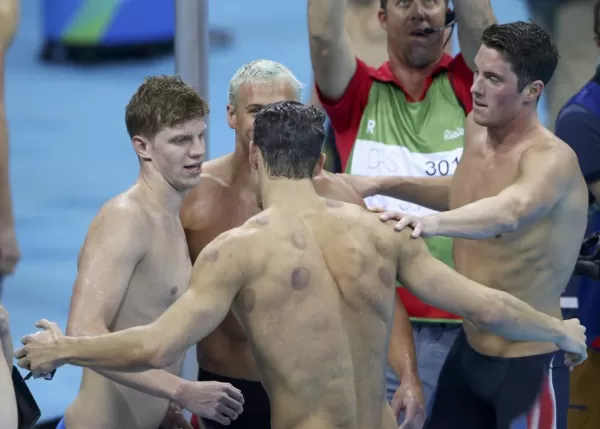 De qué son los moretones que luce Michael Phelps en su espalda