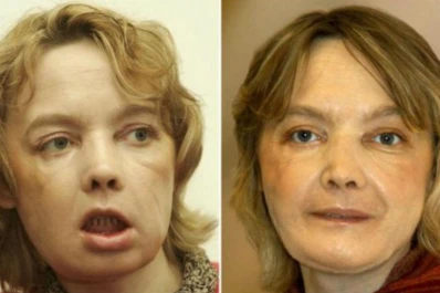 Murió la primera paciente en recibir un trasplante de cara