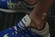 Así quedaron los pies de Del Potro luego de la derrota con Wawrinka