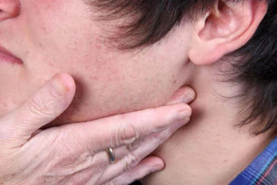 La hinchazón facial es el primer síntoma de las paperas