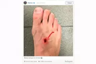 Así le quedó el pie al jugador de Atlético Madrid tras la patada de Luis Súarez