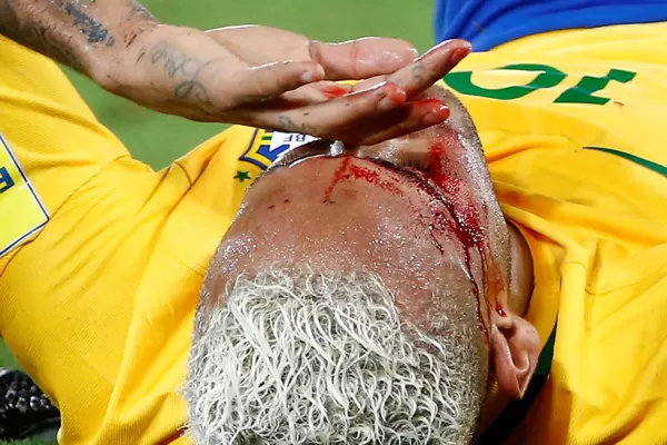 El terrible codazo que recibió Neymar le dejó la cara ensangrentada