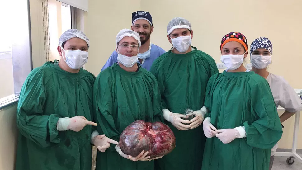 Le extirparon un tumor maligno de 15 kilos a una mujer en Catamarca