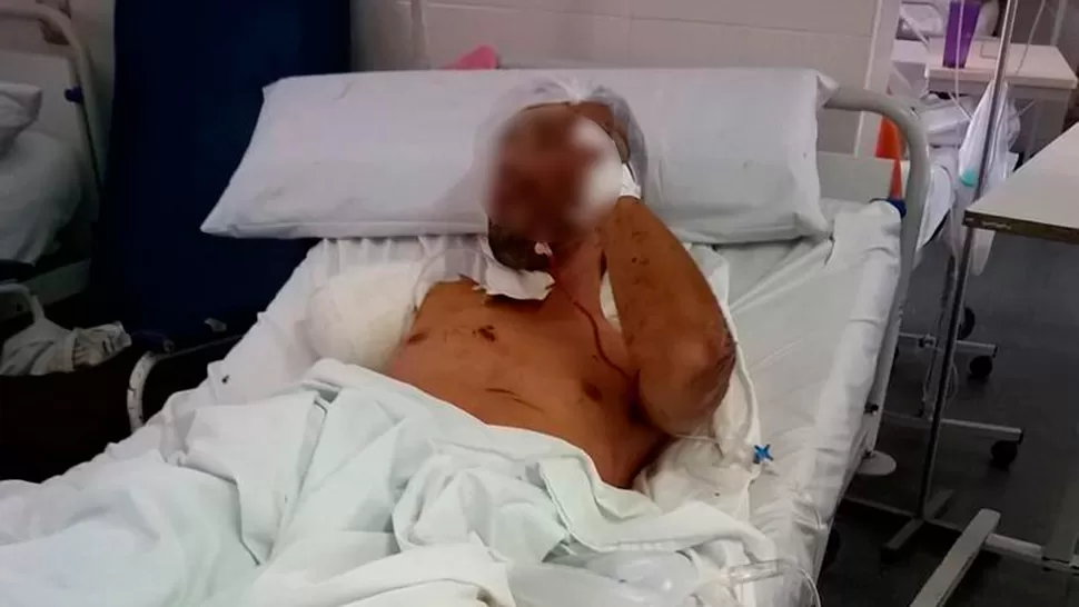 EN REPOSO. El hombre atacado por el perro, tras la amputación del brazo.  