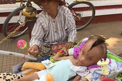 Un nene de Camboya vive con la cabeza partida en dos y su familia busca ayuda
