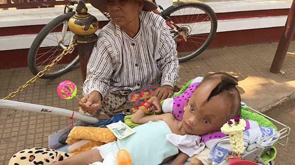 Un nene de Camboya vive con la cabeza partida en dos y su familia busca ayuda