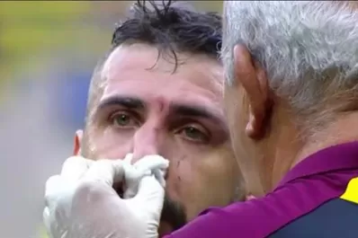 Lucas Pratto fue operado de una fractura en la nariz