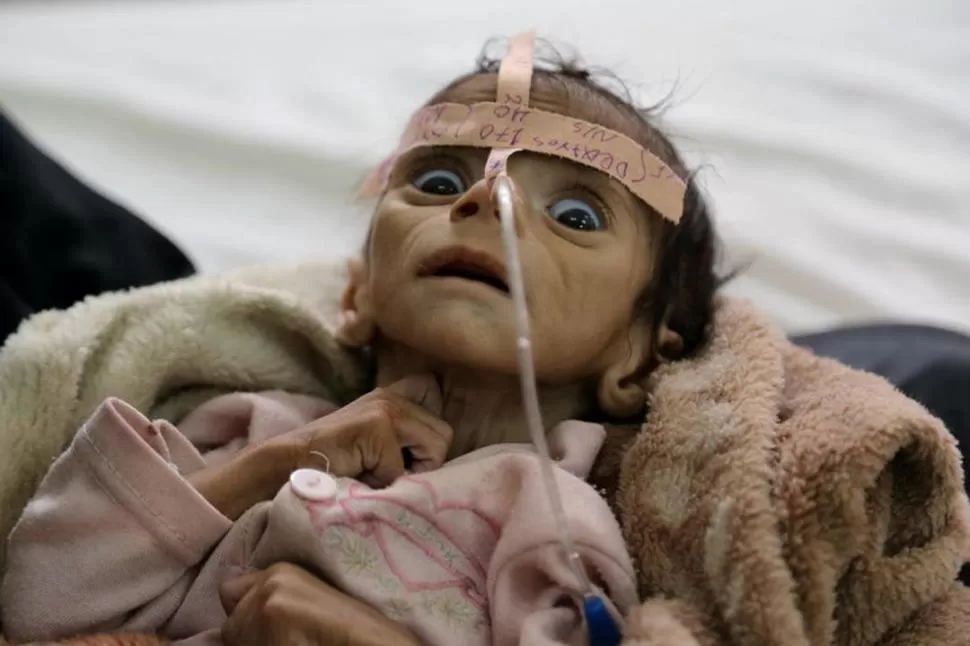 EL GESTO DE LA DESESPERANZA. Udai Faisal fue hospitalizado a comienzos de este mes en Sana, Yemen. Padecía desnutrición aguda. Murió a los pocos días. Maad al-Zikry / Associated Press