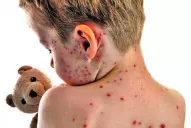 Hay un caso de sarampión confirmado y otro sospechoso